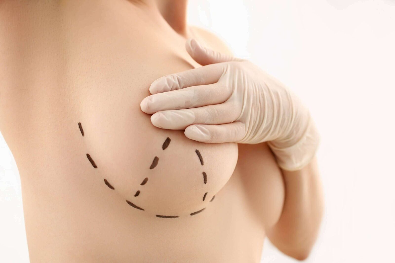 breast lift consultation