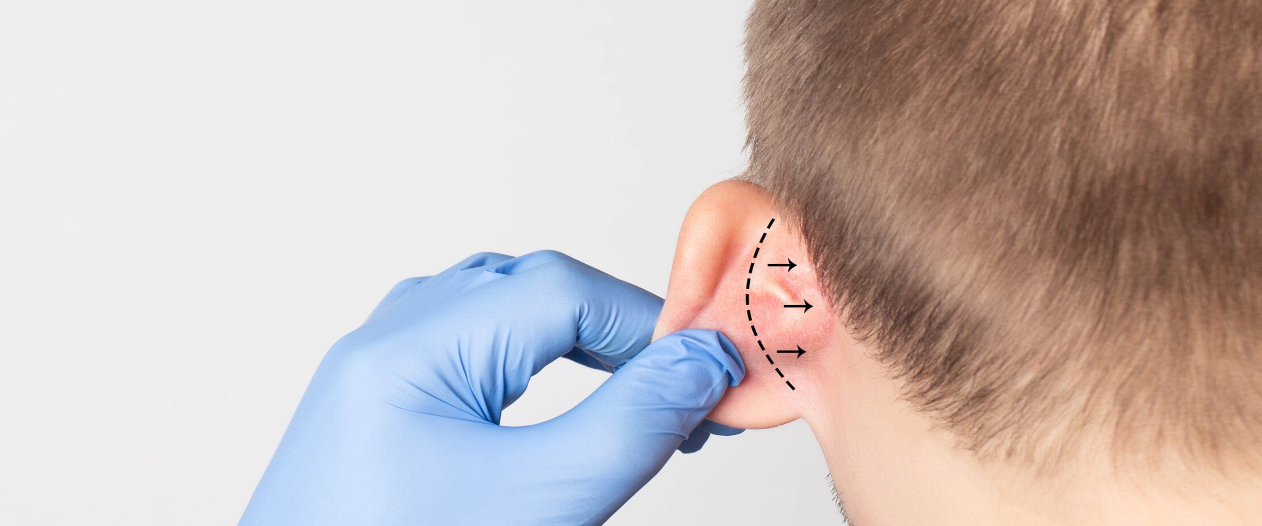 ear correction or otoplasty
