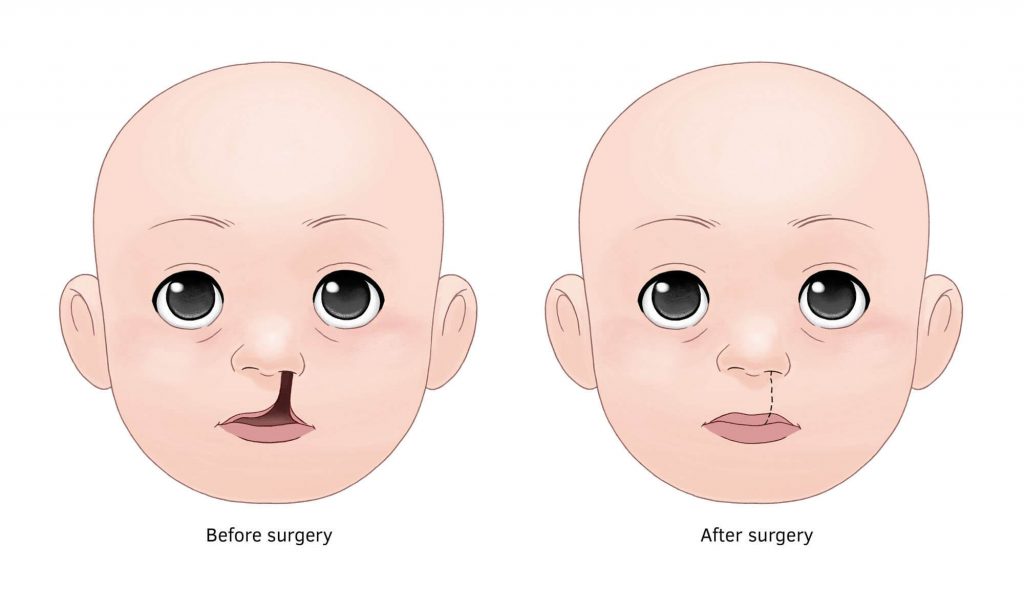  congeital plastic surgery