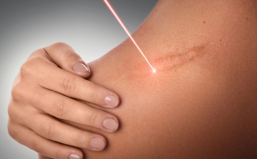 laser scar reduction