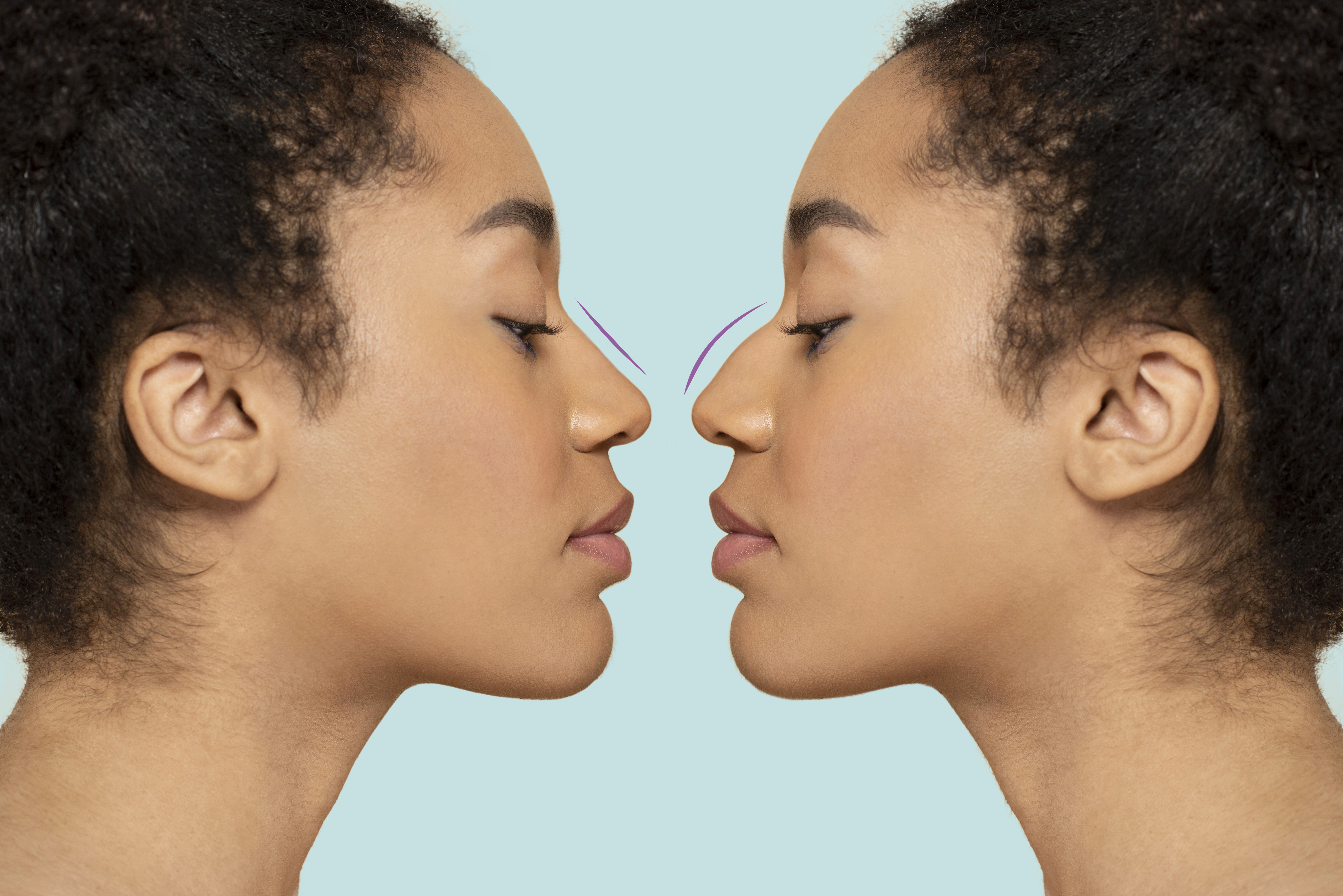 rhinoplasty consultation