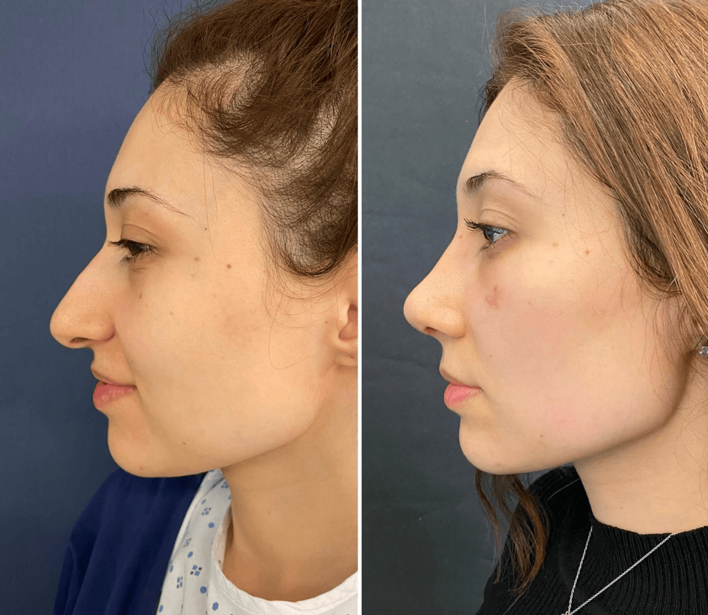 rhinoplasty consultation
