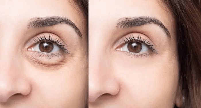 rhinoplasty consultation